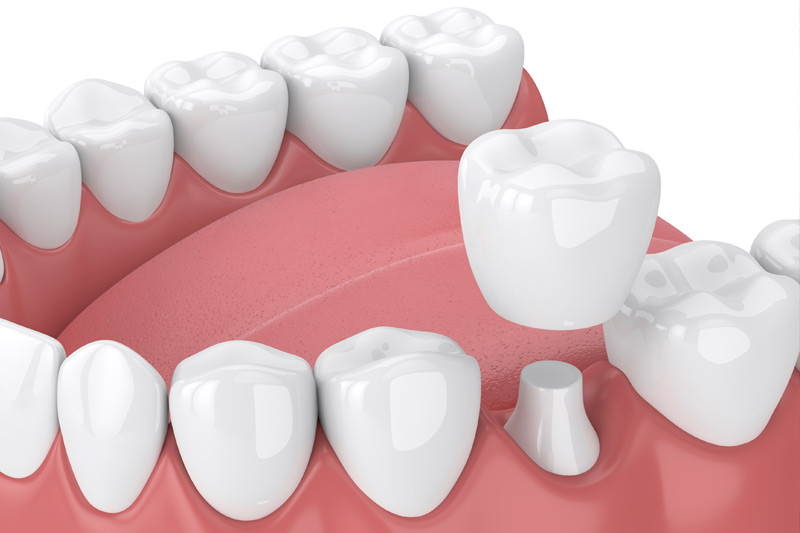 Dental Crowns in Paramount
