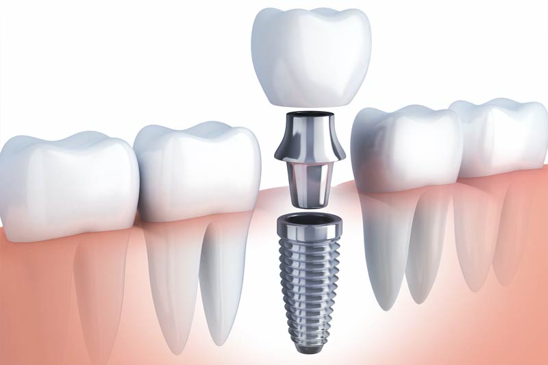 Implants Dentist in Paramount