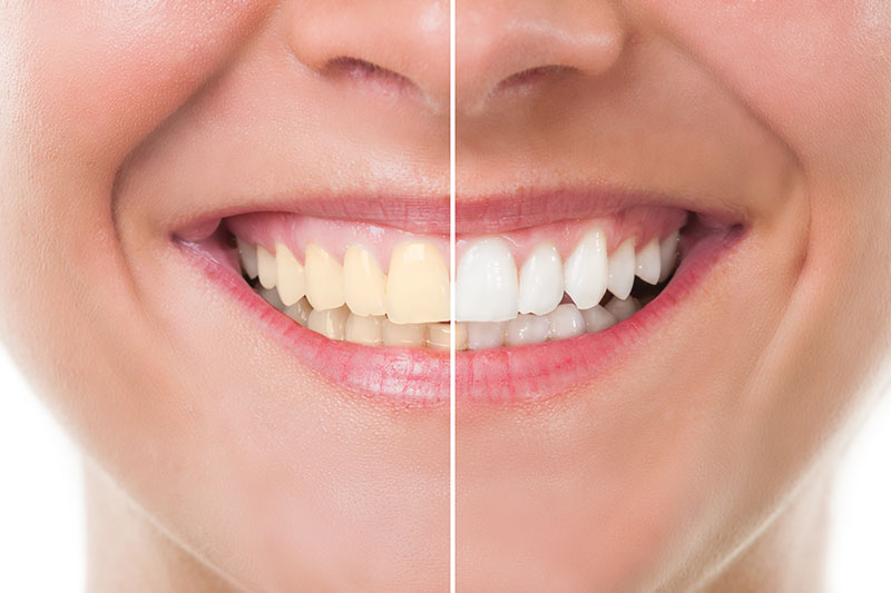 Open Door Dental Special Offer