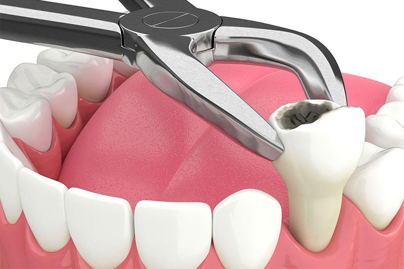Tooth Extraction in Paramount