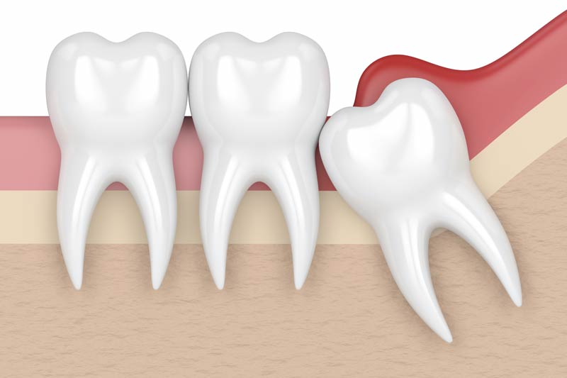 Wisdom Tooth Removal in Paramount